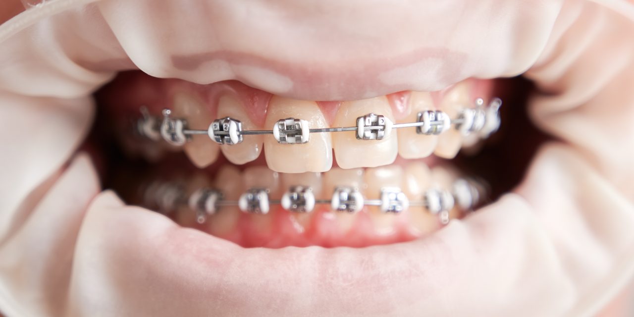 Male patient with cofferdam in mouth showing teeth with braces.
